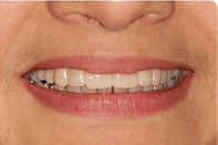 Before and after midline space closure with ceramic veneers for patient Priya Sharma at Perfect Dental Studio